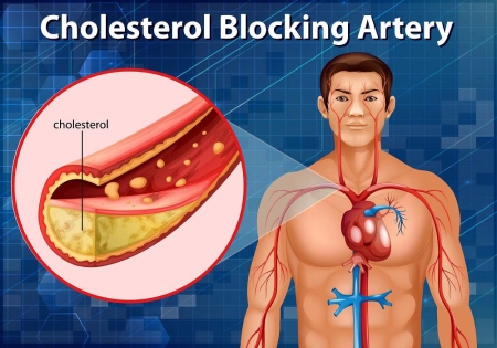 Холестерин. Кровеносные сосуды